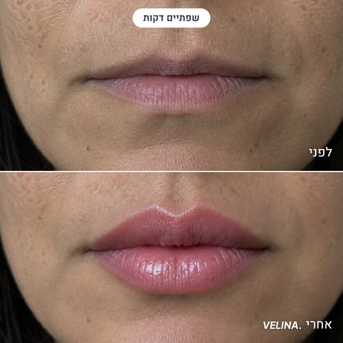 MicroLift System